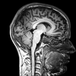 MRI_brain_sagittal_section